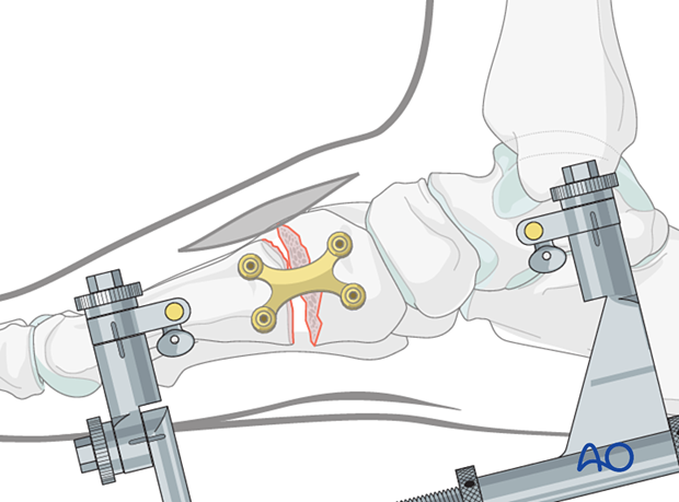 Plate application for fusion of the first tarsometatarsal joint