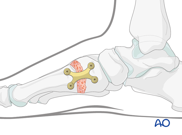 Addition of bone graft to plate fusion of the first tarsometatarsal joint