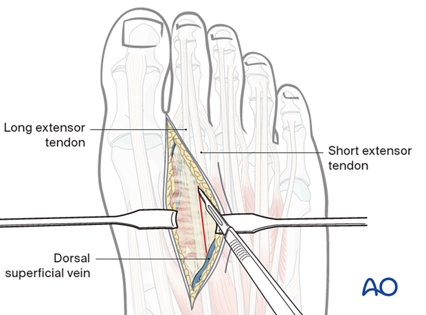 The optimal approach goes inbetween the long and the short extensor tendon of the corresponding ray.