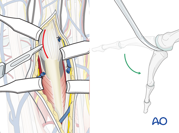 Joint capsule incision of the dorsal approach to the second metatarsal