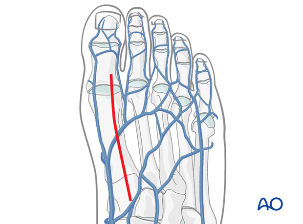 Skin incision of the dorsal approach to the first metatarsal