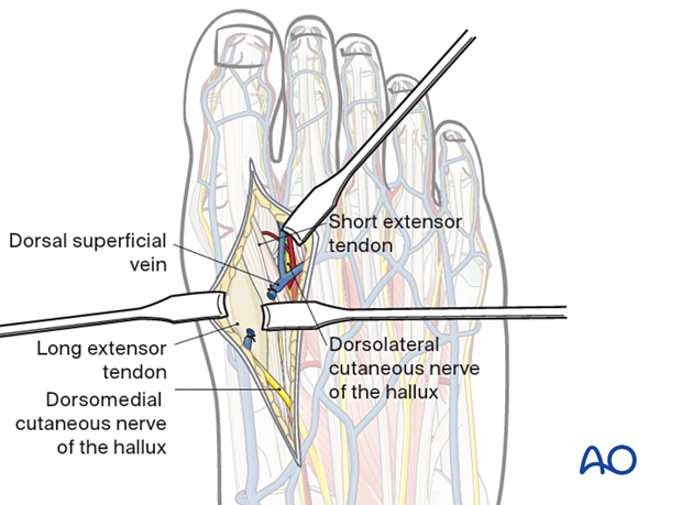 Deep dissection of the dorsal approach to the second metatarsal with retraction of the EDL tendon and exposure of the first metatarsal