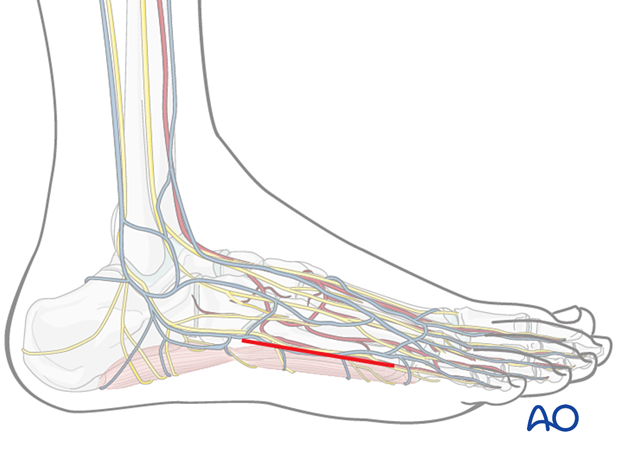 Skin incision of the lateral approach to the fifth metatarsal