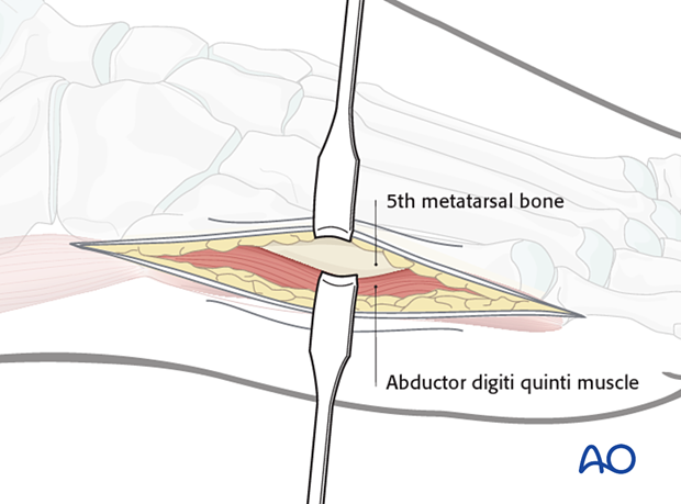 Using Langenbeck retractors, retraction of the skin and fascia dorsally, and the muscle belly in a plantar direction, exposing the fifth metatarsal