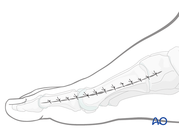 Wound closure of the medial approach to the first metatarsal