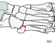 Jones Fracture