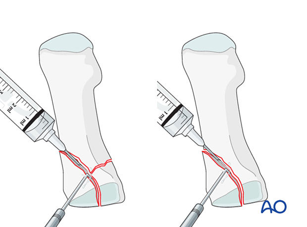 Irrigation of a proximal articular fracture of the 1st metatarsal