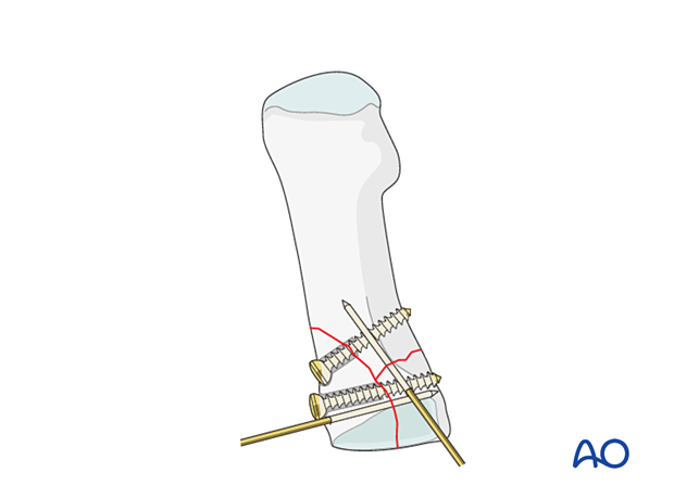 Screw fixation of the articular block to the shaft in a proximal articular fracture of the 1st metatarsal