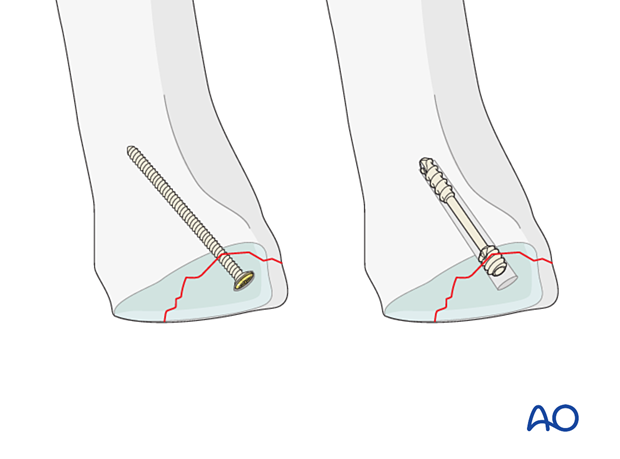 Screw fixation of a small osteochondral fragment of the 1st metatarsal proximal articular surface