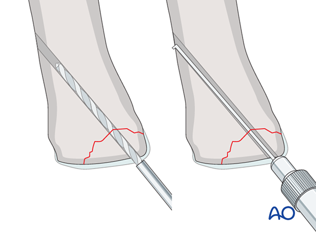 Drilling and measuring for screw fixation of a small osteochondral fragment of the 1st metatarsal proximal articular surface