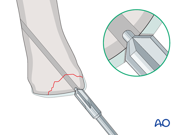 Countersinking of the articular cartilage for screw fixation of a small osteochondral fragment of the 1st metatarsal proximal articular surface