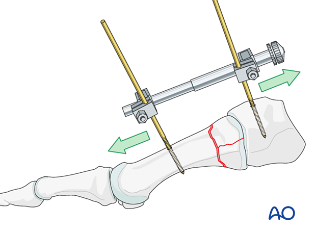 Exposure of the proximal articular surface of the 1st metatarsal with a mini distractor