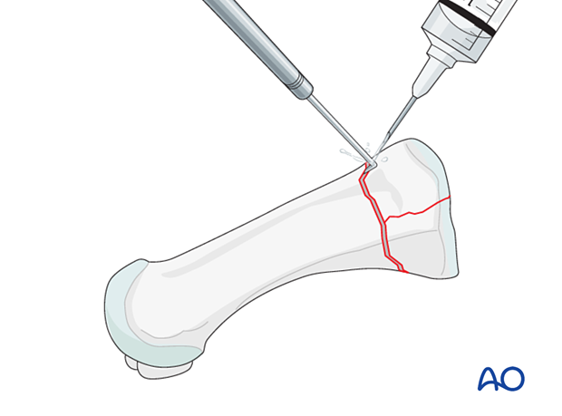 Irrigation of a proximal articular fracture of the first metatarsal