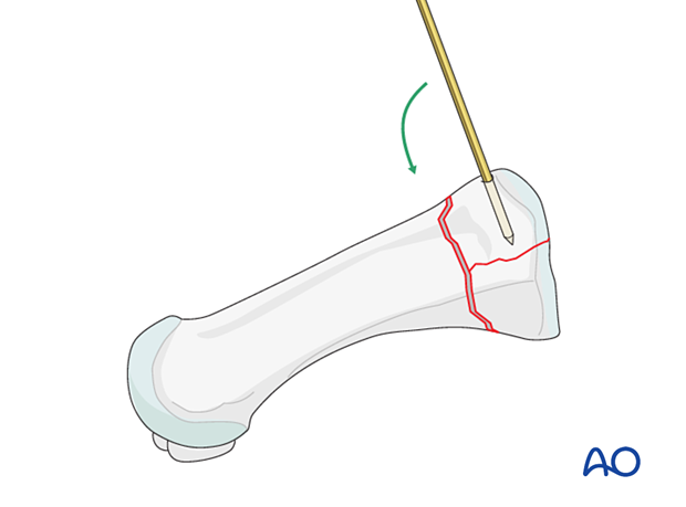 Reduction of an articular fragment of a proximal complete articular metatarsal fracture with a K-wire as a joystick