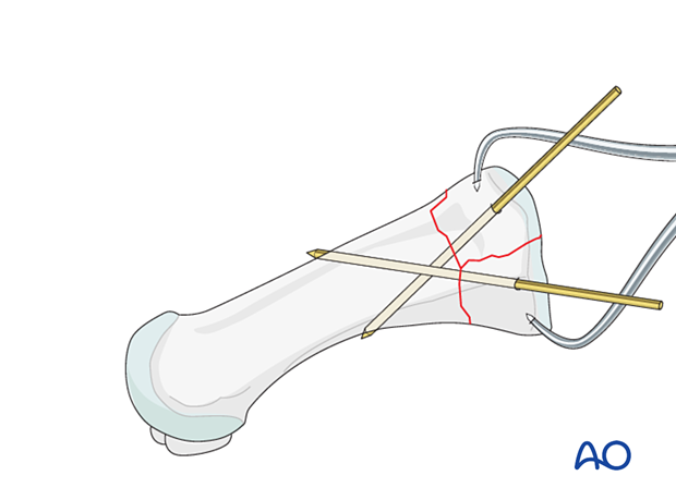 Preliminary fixation of a proximal complete articular fracture of the 1st metatarsal