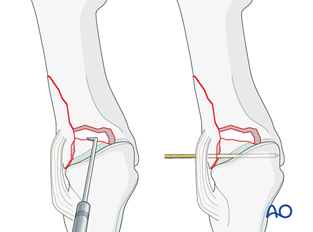 Reduction of the articular surface of an impacted proximal complete articular fracture of the 1st metatarsal