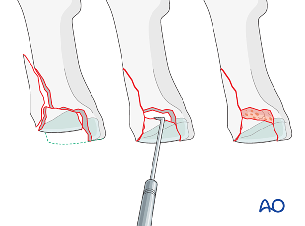 Grafting of the metaphyseal cancellous bone of an impacted proximal complete articular fracture of the 1st metatarsal