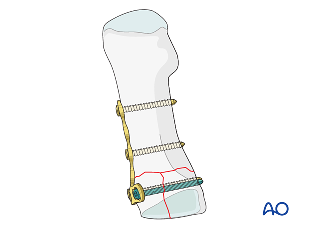 Fixation of a proximal complete articular fracture of the first metatarsal with a locking T-plate