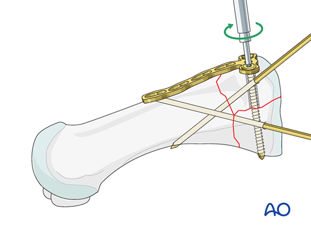 Lag screw fixation of the articular block of a proximal complete articular fracture of the 1st metatarsal