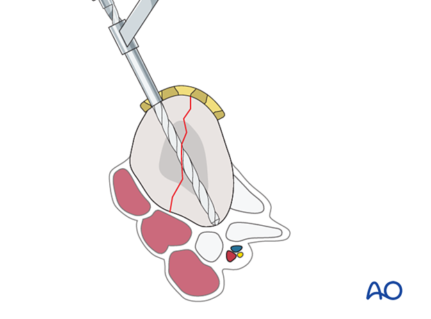 Drilling for locking screw insertion into the articular block of a proximal complete articular fracture of the 1st metatarsal