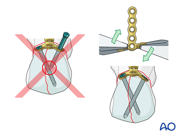 Insertion of locking screws into the articular block of a proximal complete articular fracture of the 1st metatarsal