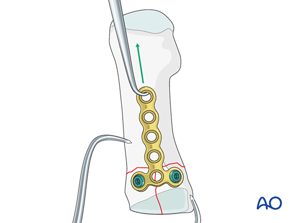 Compression of the extraarticular fracture component of a proximal complete articular fracture of the 1st metatarsal