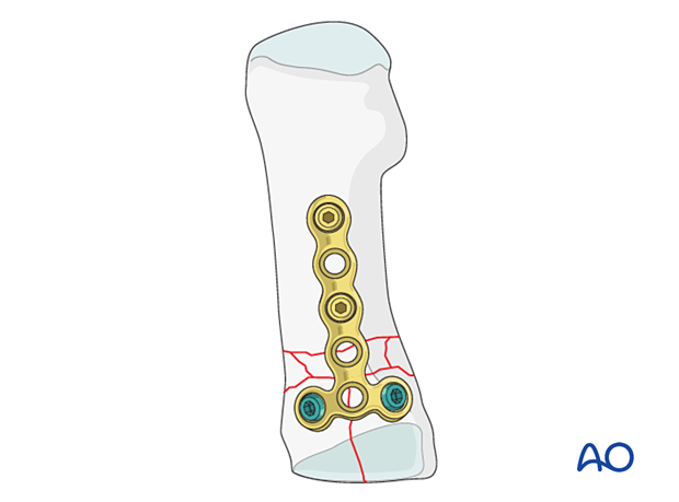 Bridge plating of a proximal complete articular fracture of the 1st metatarsal with metaphyseal comminution