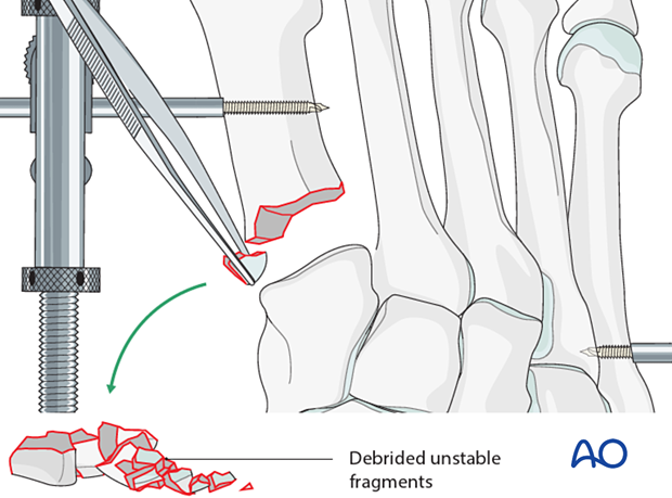 Debridement of a proximal articular fracture of the 1st metatarsal