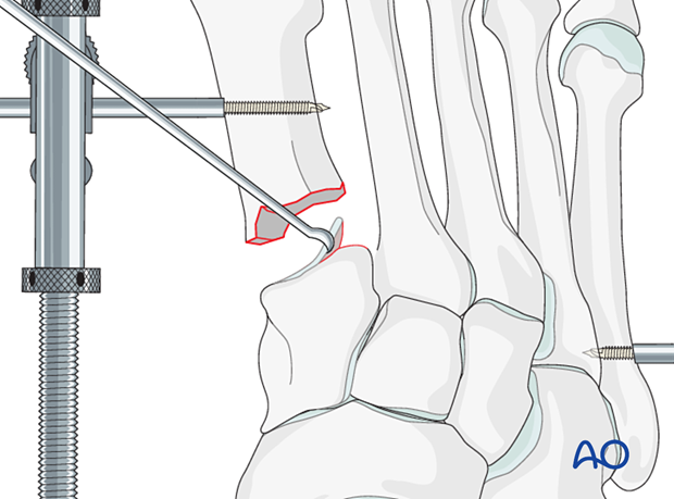 Cartilage removal of the adjacent bone for arthrodesis of the 1st TMT joint