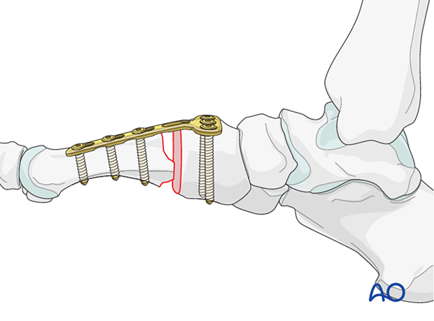 Arthrodesis of a TMT joint with a plate