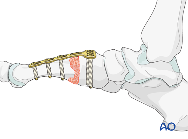 Arthrodesis of a TMT joint with a plate and bone graft