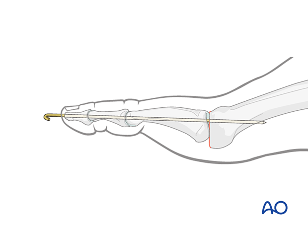 Temporary K-wire immobilization for excision arthroplasty of the MTP joint