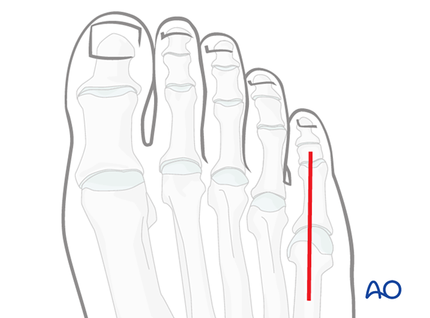 Skin incision for approach to the 5th toe