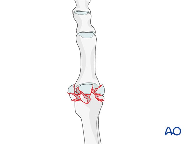 Comminuted articular fracture of the proximal 2nd metatarsal