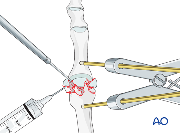 Irrigation of the MTP joint