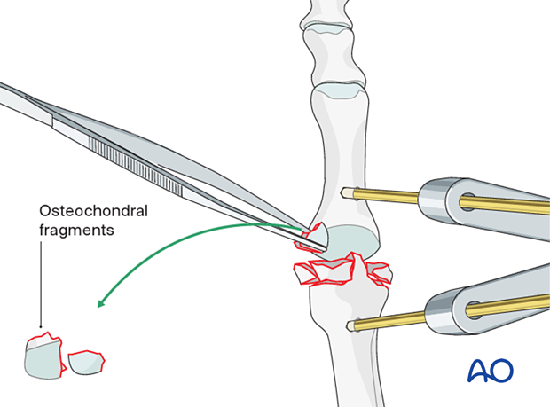 Debridement of unstable fragments of the MTP joint