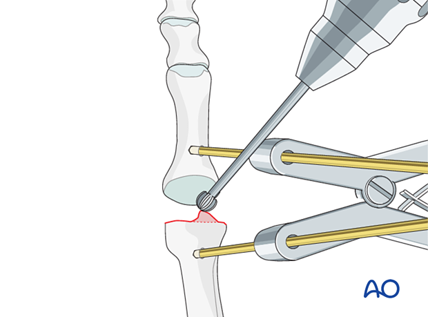 Debriding fracture edges with a high-speed burr of the distal metatarsal