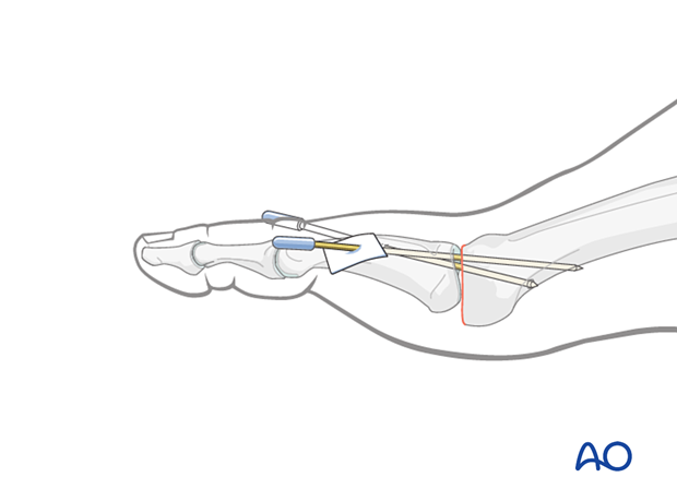 K-wire insertion for temporary support of the arthroplasty of the MTP joint