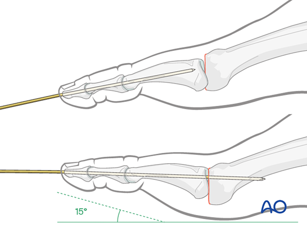 Positioning of the phalanx for K-wire insertion for temporary immobilization of the MTP joint