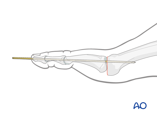 Temporary K-wire immobilization for excision arthroplasty of the MTP joint