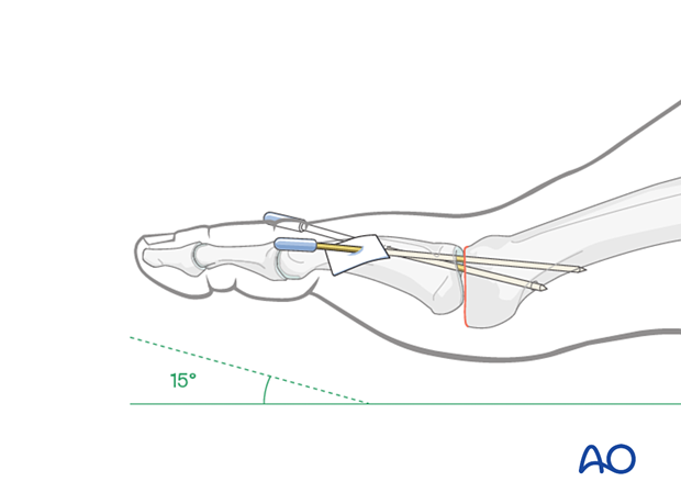 K-wire insertion for temporary support of the arthroplasty of the MTP joint