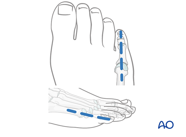 Marking the skin for K-wire insertion into the phalanx and metatarsal