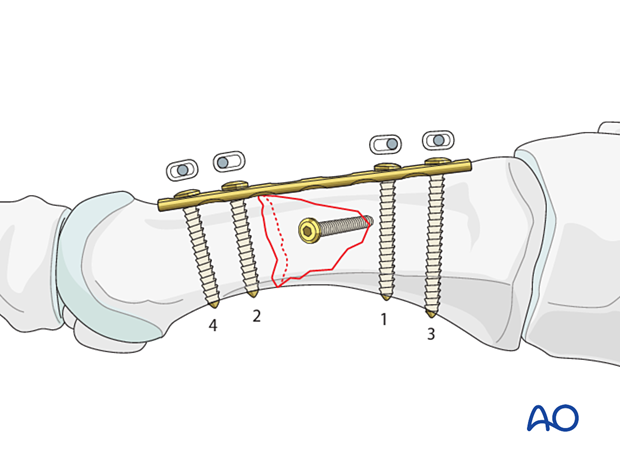 Screw and compression plate fixation of a wedge diaphyseal metatarsal fracture