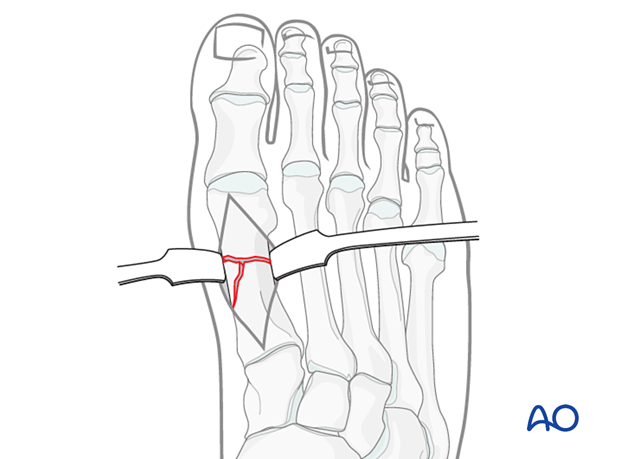 Exposure of a wedge diaphyseal fracture of the 1st metatarsal