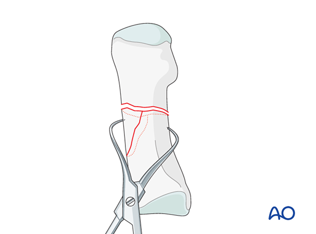 Reduction of the wedge fragment of the 1st metatarsal to one of the main fragments with a reduction forceps