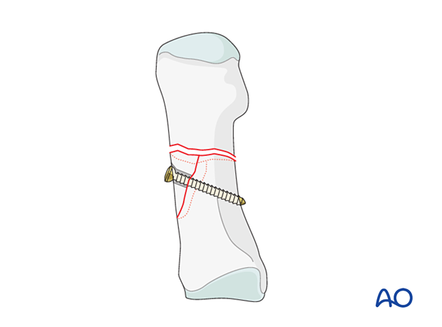 Screw fixation of the wedge fragment of the 1st metatarsal to one of the main fragments