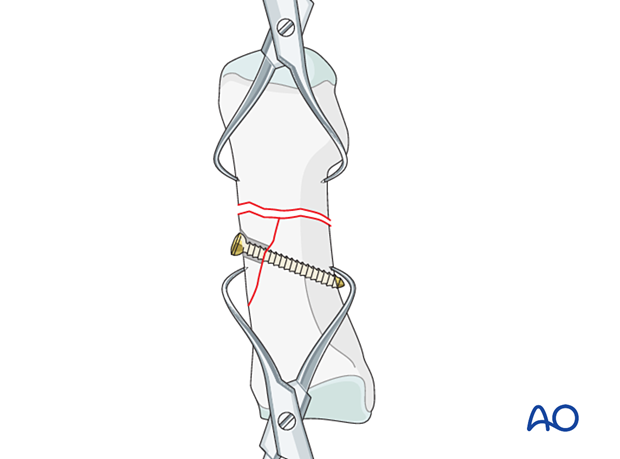 87 P200 Compression plate fixation