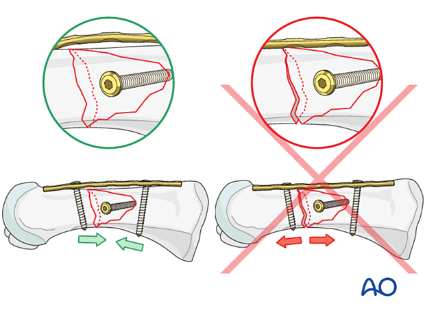 87 P200 Compression plate fixation