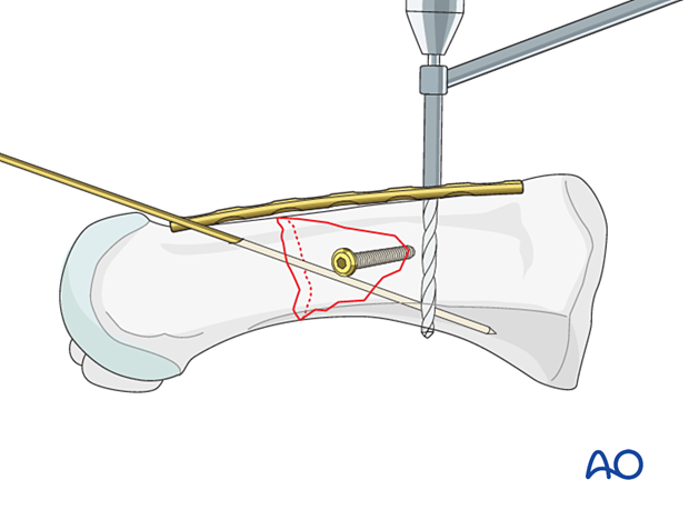 87 P200 Compression plate fixation