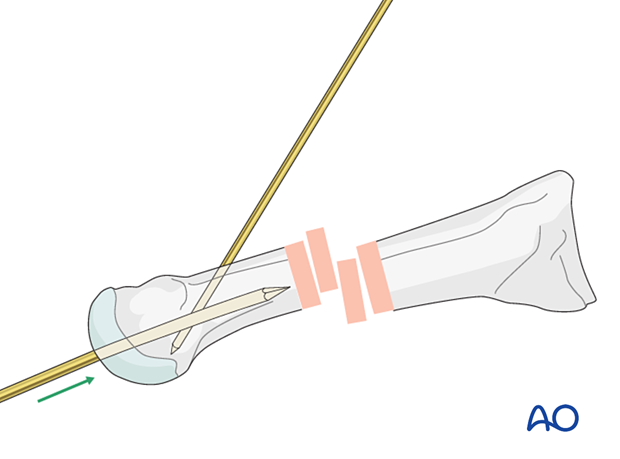 Intramedullary K Wire Fixation For Distal Extraarticular Fractures Of